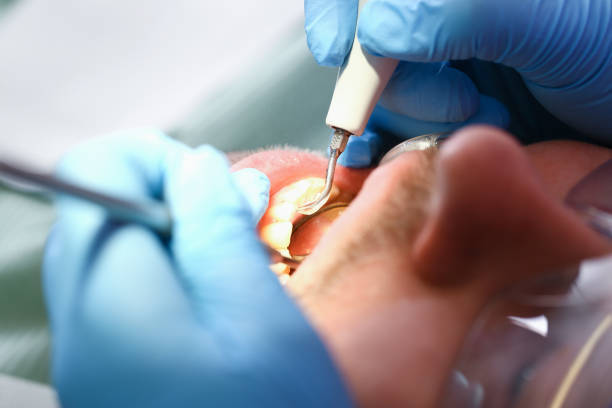 Best Emergency Treatment for Dental Infections or Abscesses in Sedona, AZ