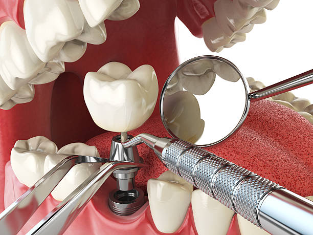 Best Urgent Care for Lost Fillings or Crowns in Sedona, AZ